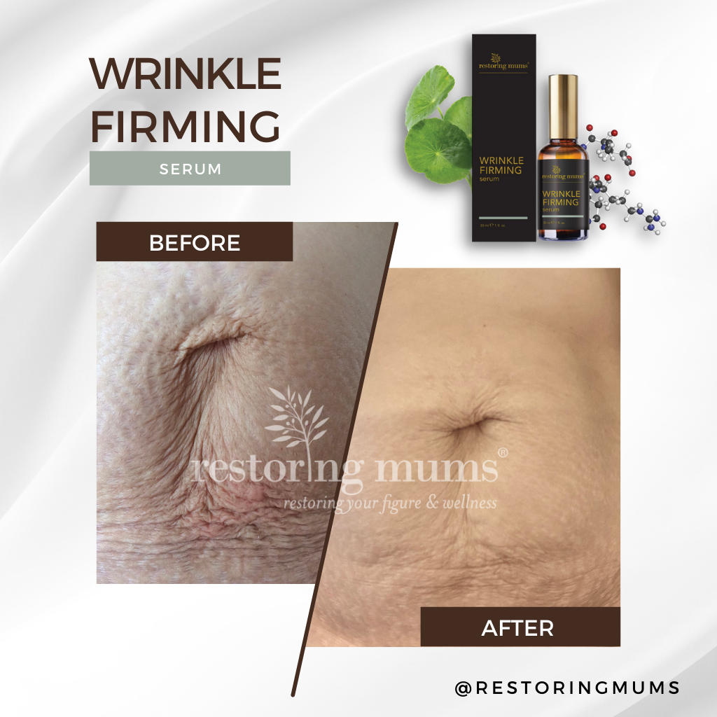 Wrinkly Tummy Skin Solution